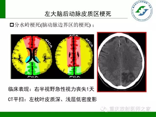 【PPT】脑静脉解剖及相关疾病影像学诊断-66
