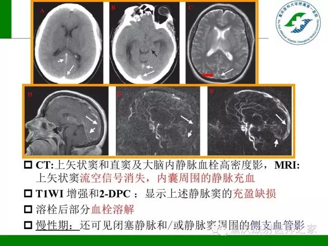 【PPT】脑静脉解剖及相关疾病影像学诊断-37