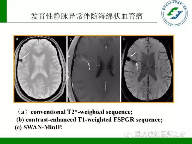 【PPT】脑静脉解剖及相关疾病影像学诊断-54