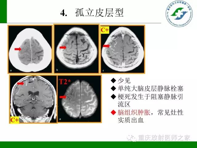 【PPT】脑静脉解剖及相关疾病影像学诊断-28