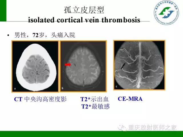 【PPT】脑静脉解剖及相关疾病影像学诊断-29