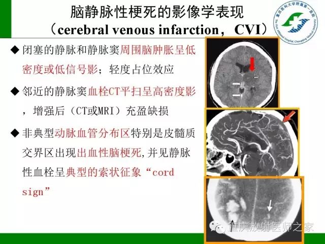 【PPT】脑静脉解剖及相关疾病影像学诊断-20