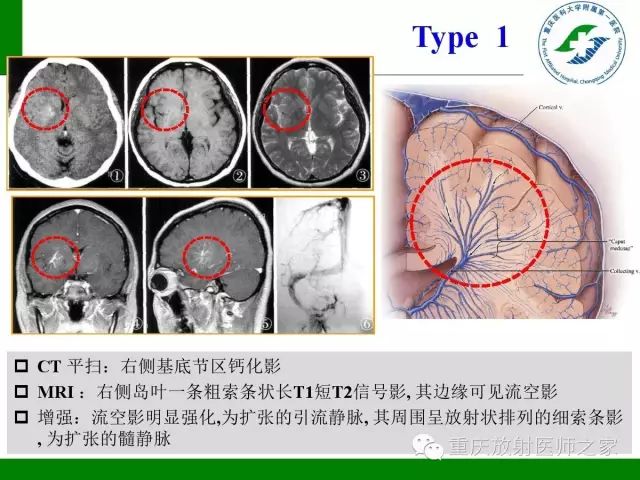 【PPT】脑静脉解剖及相关疾病影像学诊断-49