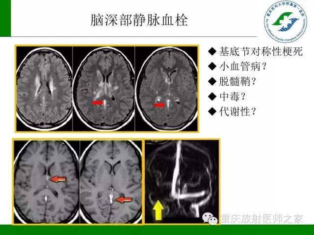 【PPT】脑静脉解剖及相关疾病影像学诊断-40