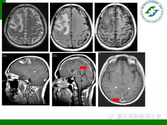【PPT】脑静脉解剖及相关疾病影像学诊断-39