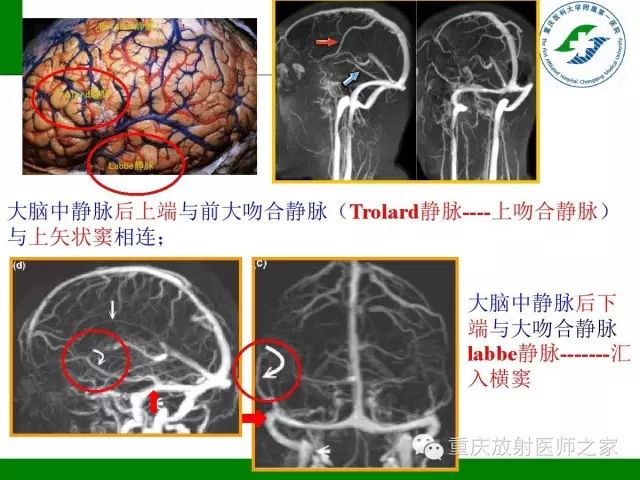 【PPT】脑静脉解剖及相关疾病影像学诊断-8