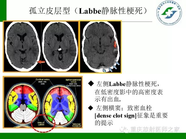 【PPT】脑静脉解剖及相关疾病影像学诊断-31