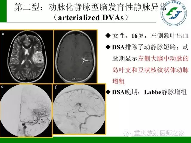 【PPT】脑静脉解剖及相关疾病影像学诊断-53