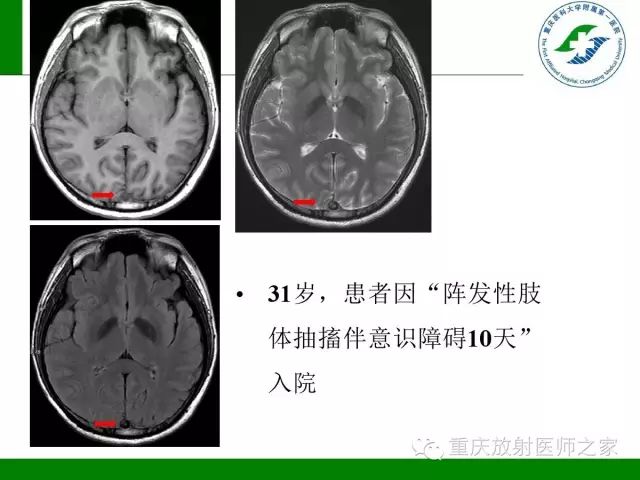 【PPT】脑静脉解剖及相关疾病影像学诊断-38