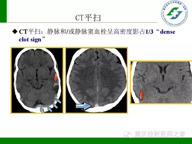 【PPT】脑静脉解剖及相关疾病影像学诊断-34