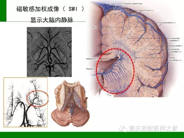 【PPT】脑静脉解剖及相关疾病影像学诊断-10