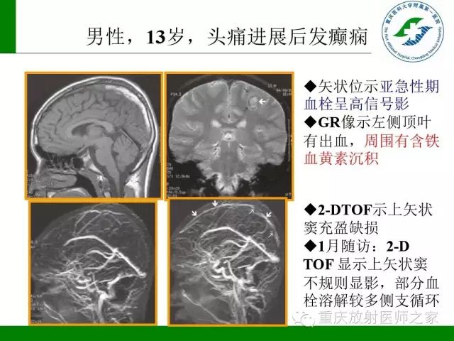 【PPT】脑静脉解剖及相关疾病影像学诊断-42