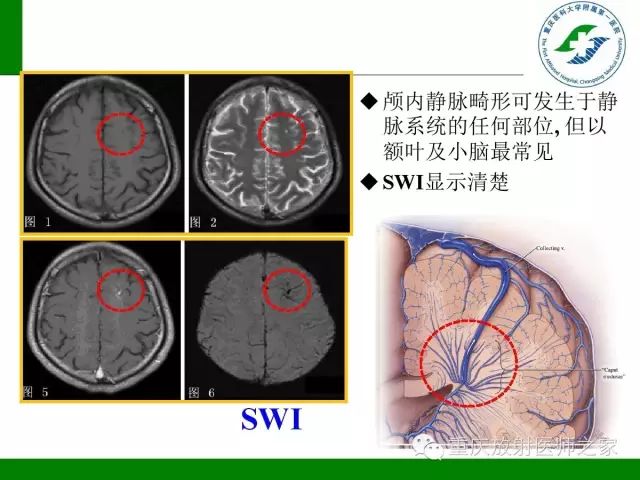 【PPT】脑静脉解剖及相关疾病影像学诊断-50