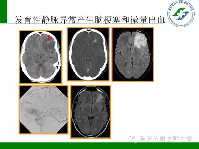 【PPT】脑静脉解剖及相关疾病影像学诊断-55