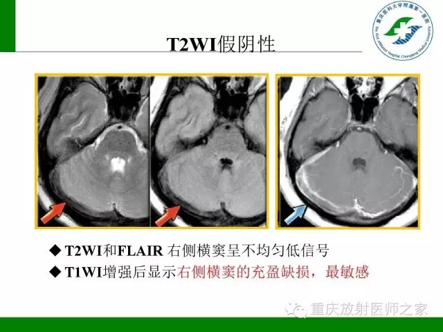 【PPT】脑静脉解剖及相关疾病影像学诊断-61
