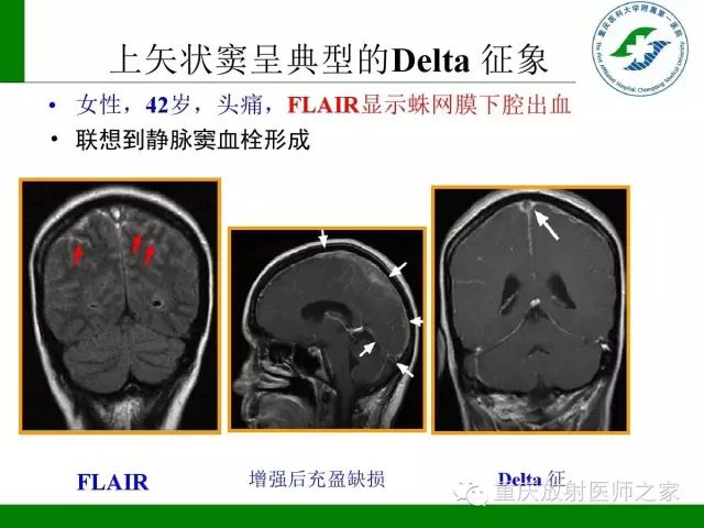 【PPT】脑静脉解剖及相关疾病影像学诊断-41