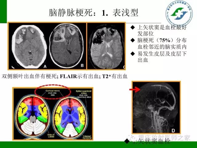 【PPT】脑静脉解剖及相关疾病影像学诊断-22
