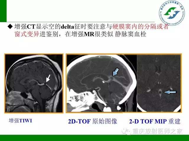 【PPT】脑静脉解剖及相关疾病影像学诊断-62