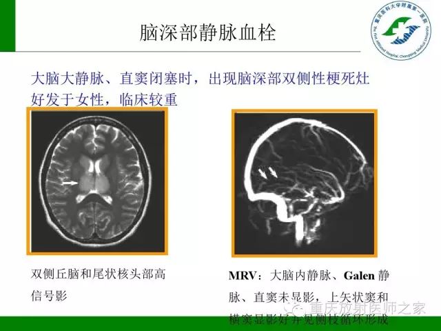 【PPT】脑静脉解剖及相关疾病影像学诊断-43