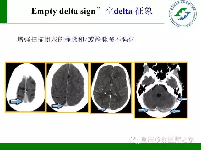 【PPT】脑静脉解剖及相关疾病影像学诊断-35