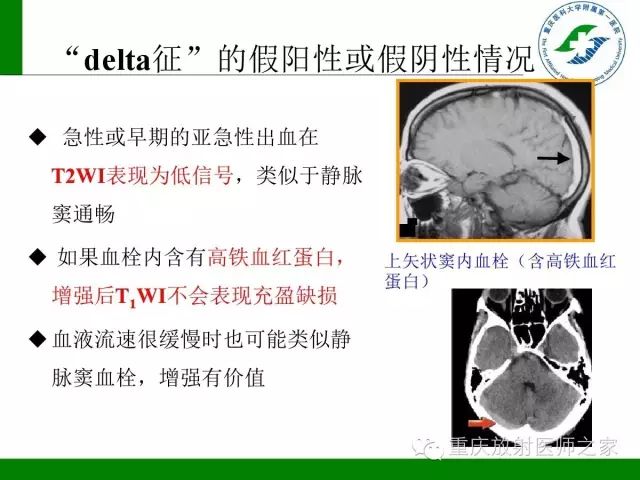 【PPT】脑静脉解剖及相关疾病影像学诊断-60
