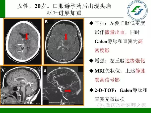 【PPT】脑静脉解剖及相关疾病影像学诊断-45
