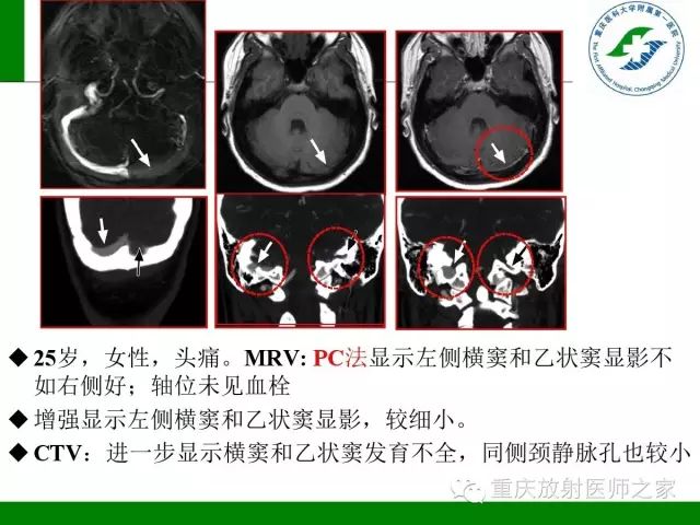 【PPT】脑静脉解剖及相关疾病影像学诊断-58