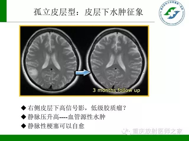 【PPT】脑静脉解剖及相关疾病影像学诊断-30