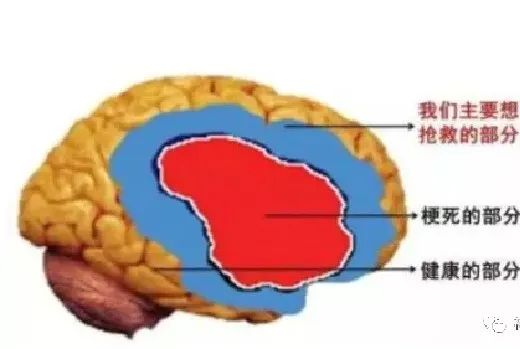 DWI、PWI在缺血性脑卒中上的应用以及联合应用对临床治疗方式选择的指导意义-15