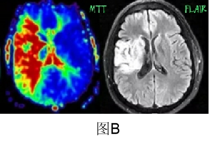DWI、PWI在缺血性脑卒中上的应用以及联合应用对临床治疗方式选择的指导意义-14