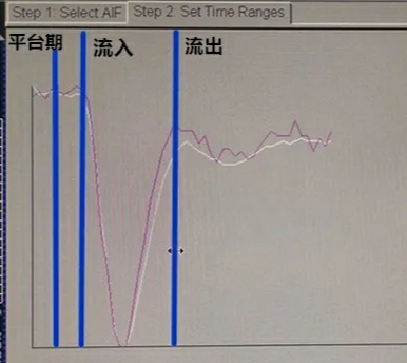 DWI、PWI在缺血性脑卒中上的应用以及联合应用对临床治疗方式选择的指导意义-10