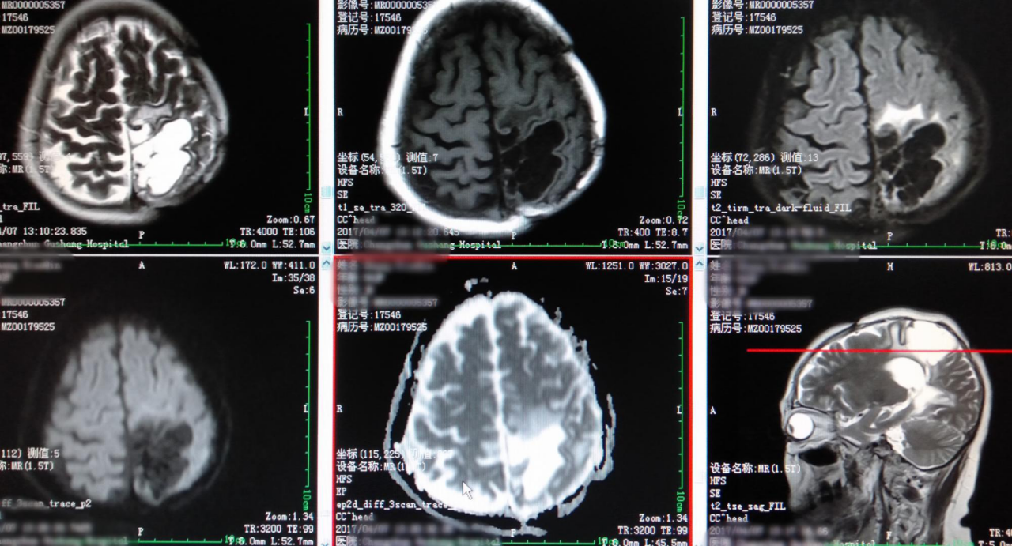 DWI、PWI在缺血性脑卒中上的应用以及联合应用对临床治疗方式选择的指导意义-8