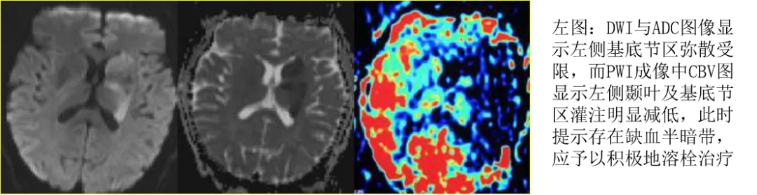DWI、PWI在缺血性脑卒中上的应用以及联合应用对临床治疗方式选择的指导意义-16
