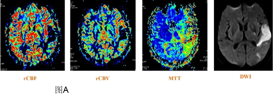 DWI、PWI在缺血性脑卒中上的应用以及联合应用对临床治疗方式选择的指导意义-13