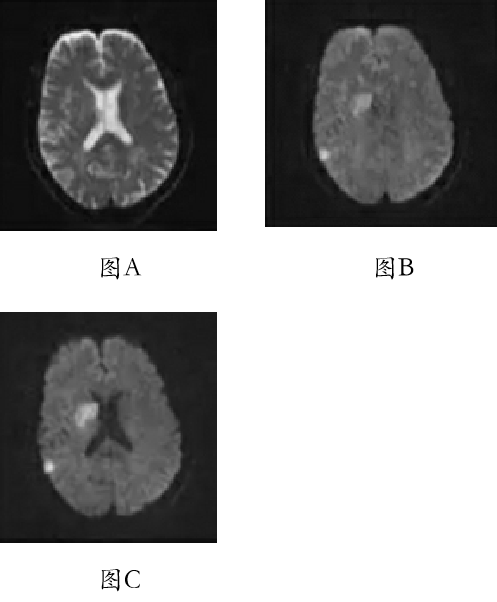 DWI、PWI在缺血性脑卒中上的应用以及联合应用对临床治疗方式选择的指导意义-2