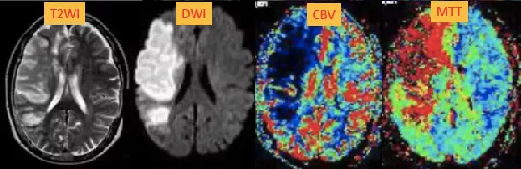 DWI、PWI在缺血性脑卒中上的应用以及联合应用对临床治疗方式选择的指导意义-18