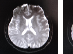 DWI、PWI在缺血性脑卒中上的应用以及联合应用对临床