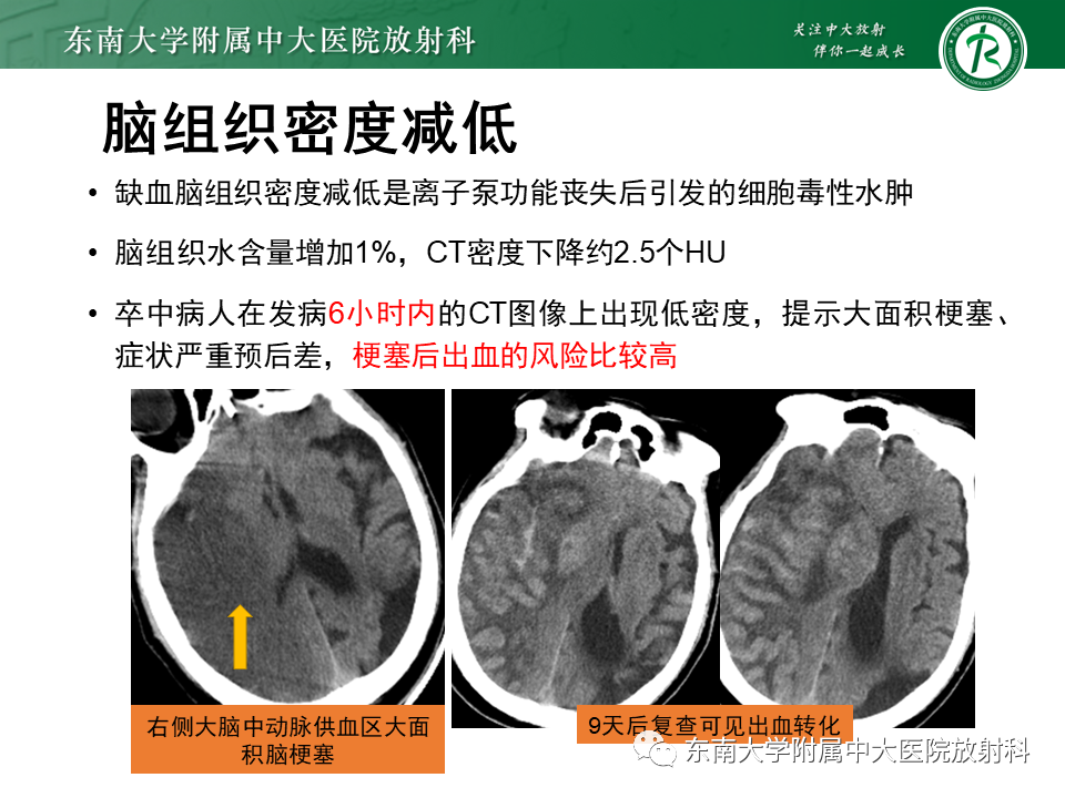【PPT】急性缺血性脑卒中的多模态CT评估-24