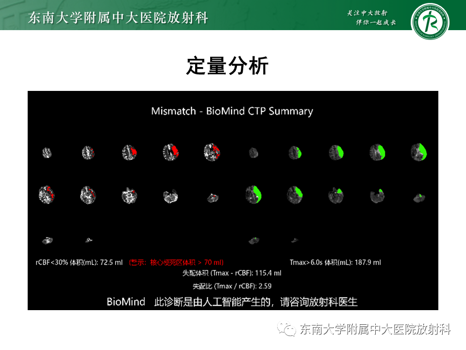 【PPT】急性缺血性脑卒中的多模态CT评估-44 【PPT】急性缺血性脑卒中的多模态CT评估-44