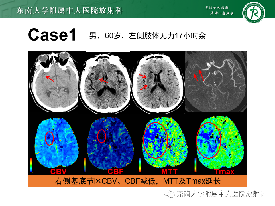 【PPT】急性缺血性脑卒中的多模态CT评估-50