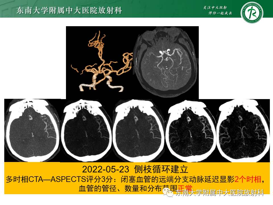 【PPT】急性缺血性脑卒中的多模态CT评估-51