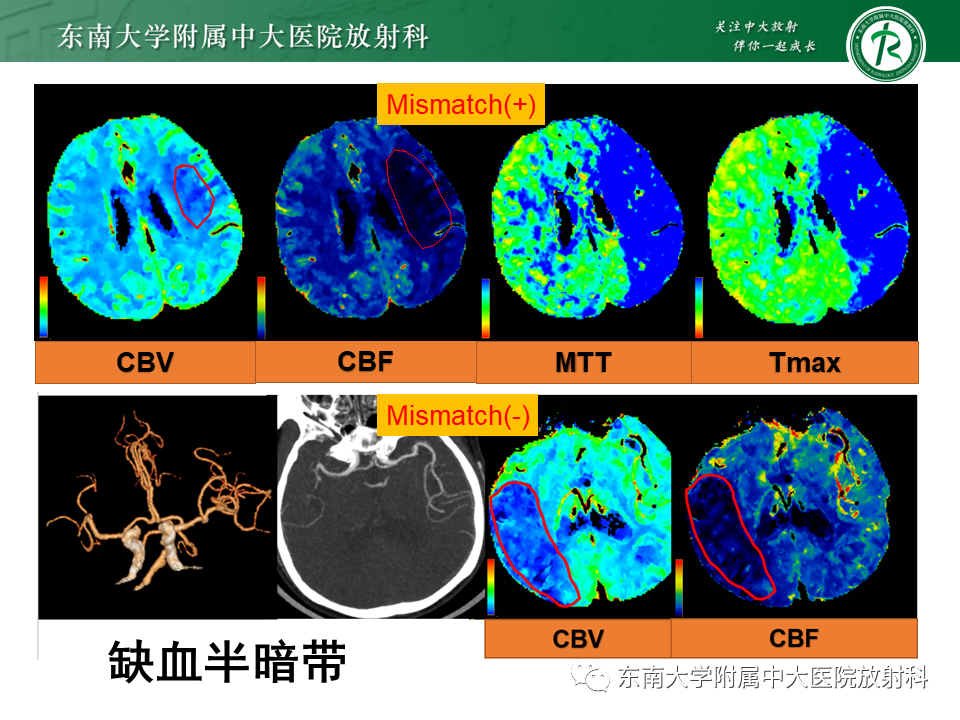 【PPT】急性缺血性脑卒中的多模态CT评估-41
