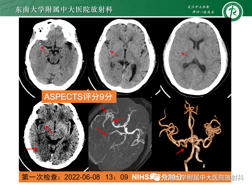 【PPT】急性缺血性脑卒中的多模态CT评估-54
