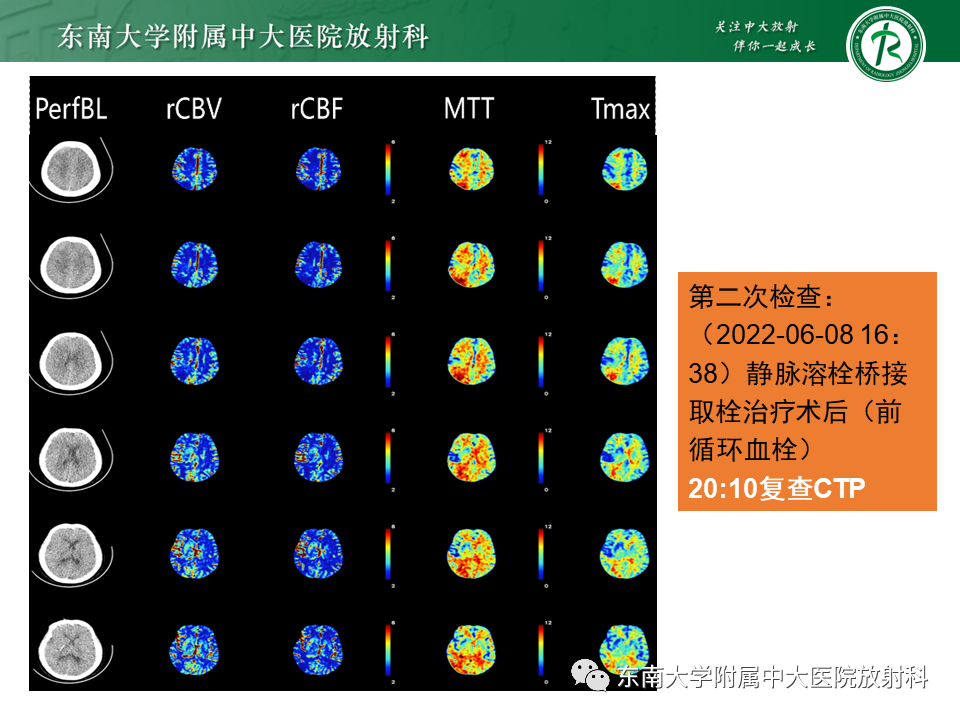 【PPT】急性缺血性脑卒中的多模态CT评估-58