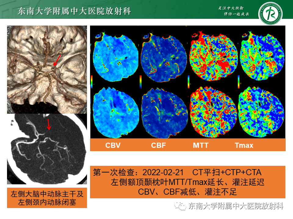 【PPT】急性缺血性脑卒中的多模态CT评估-7