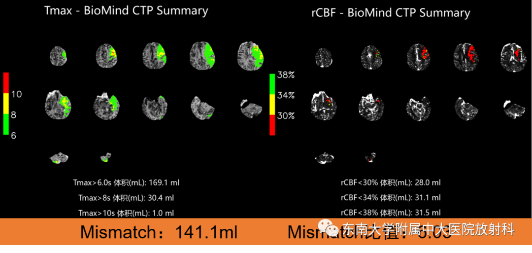 【PPT】急性缺血性脑卒中的多模态CT评估-3