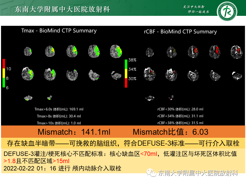 【PPT】急性缺血性脑卒中的多模态CT评估-8 【PPT】急性缺血性脑卒中的多模态CT评估-8