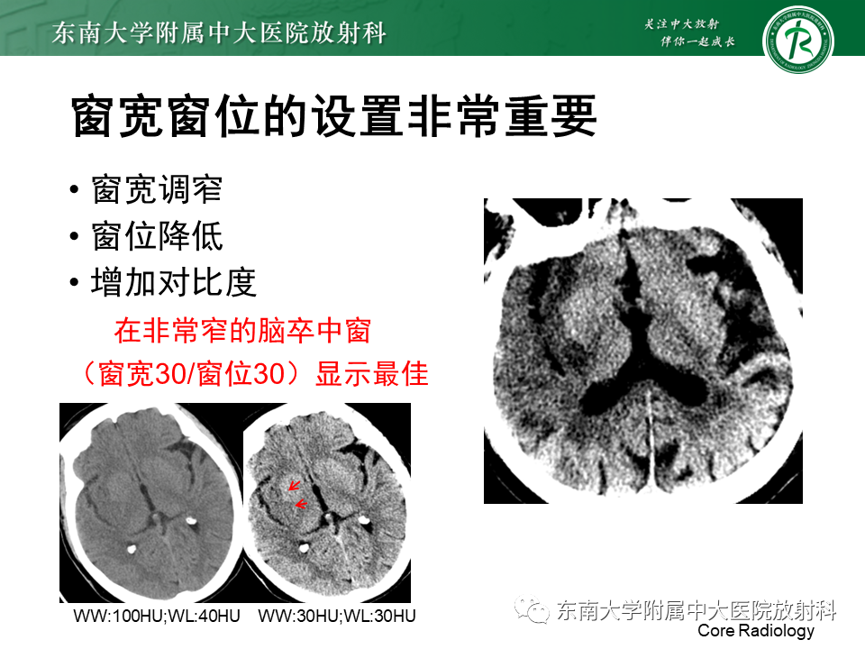 【PPT】急性缺血性脑卒中的多模态CT评估-27