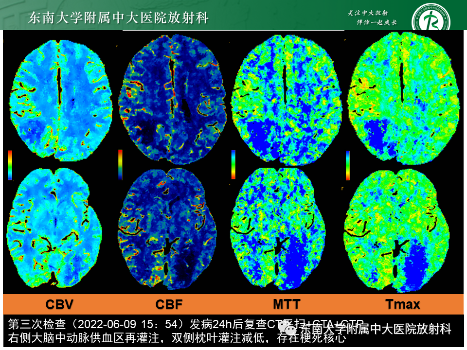【PPT】急性缺血性脑卒中的多模态CT评估-61