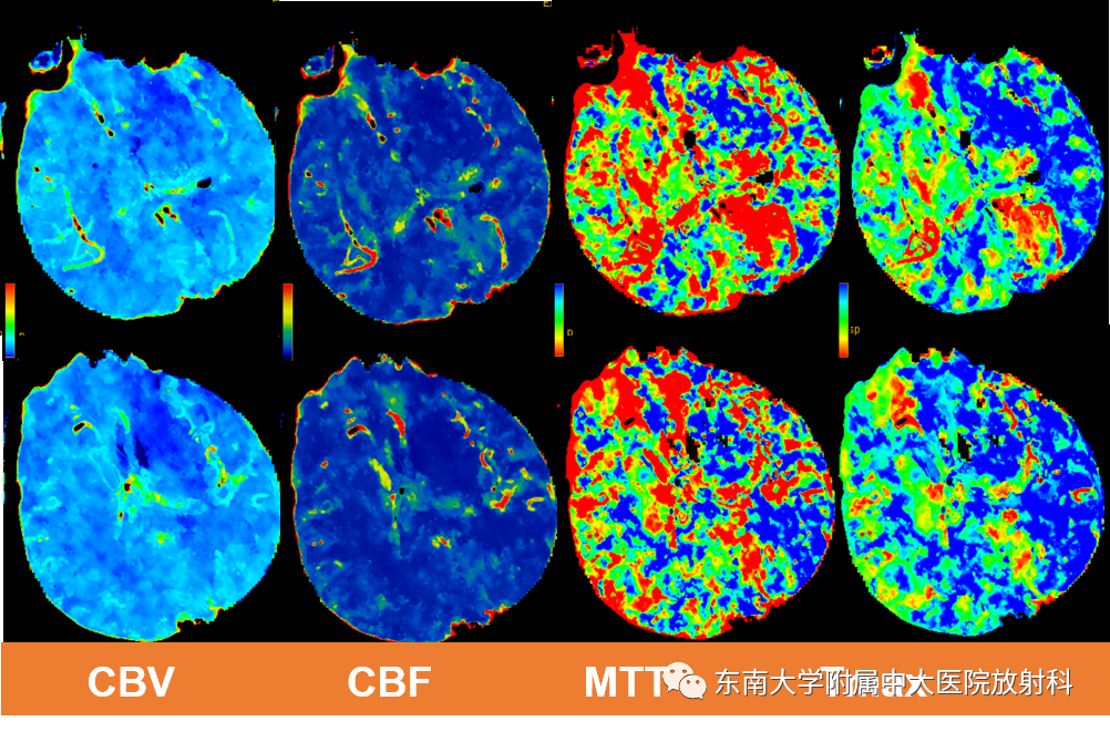 【PPT】急性缺血性脑卒中的多模态CT评估-2